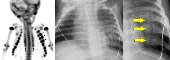 Posterior Rib Fractures